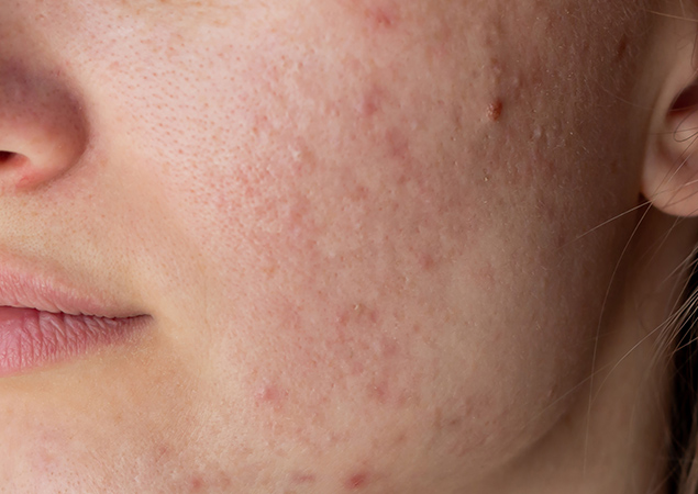 Acne Before Treatment