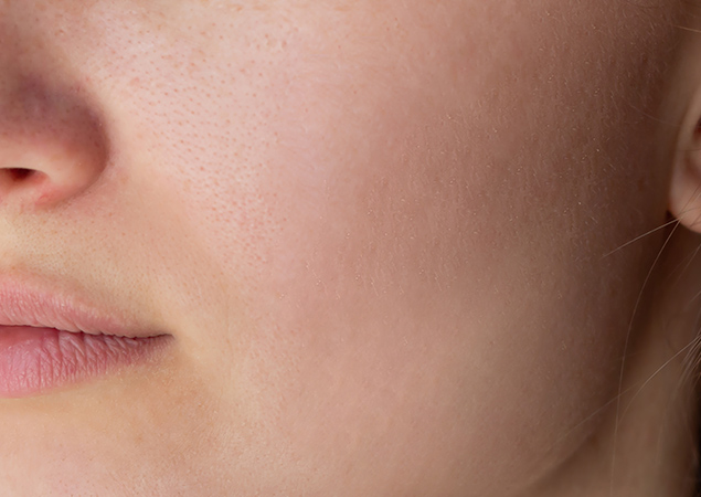 Acne After Treatment